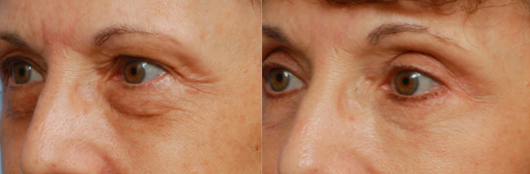 Annapolis Facial Plastic Surgeon for Eyelid Surgery