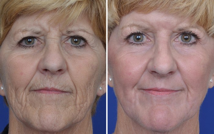 Annapolis Laser Eyelid Rejuvenation Before & After