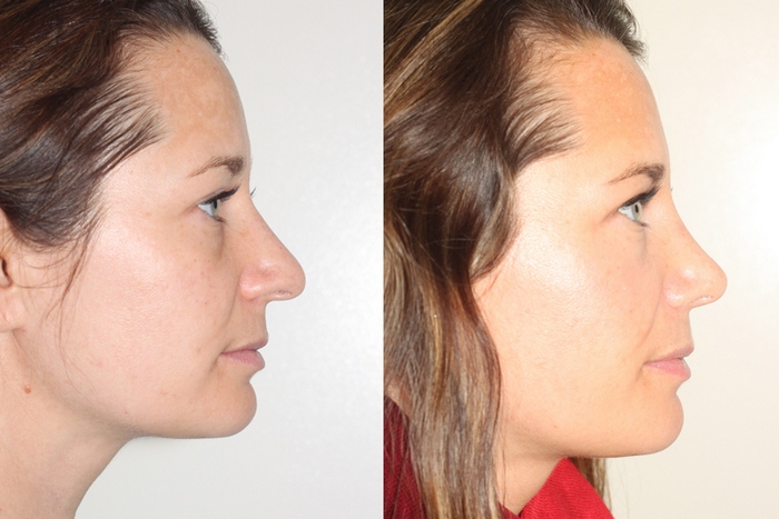 ba-rhinoplasty