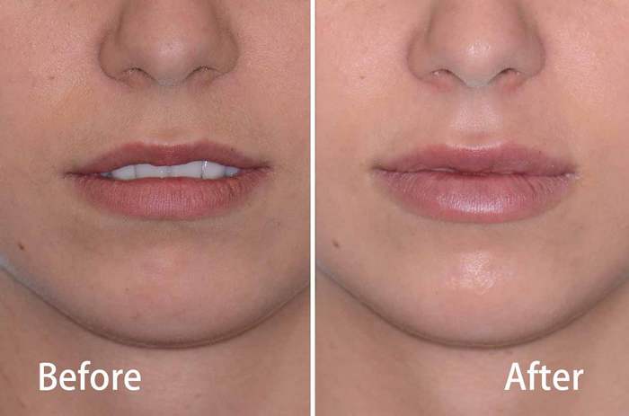 juvederm-mouths