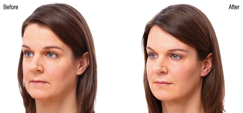 Juvederm Voluma before after