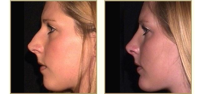 rhinoplasty-content