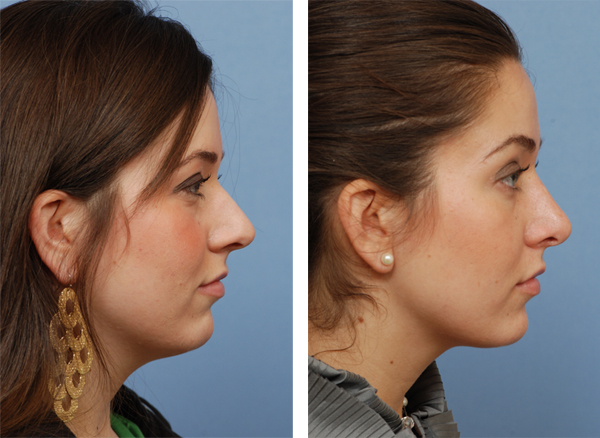 rhinoplasty